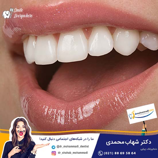 روش های سفید کننده دندان خانگی کدامند؟ - کلینیک دندانپزشکی دکتر شهاب محمدی